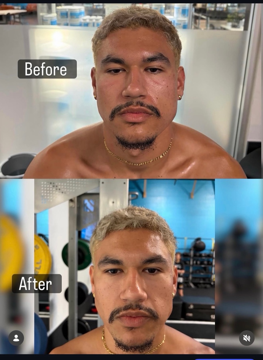 Client before and after The Facelift Method, showing the face and jawline