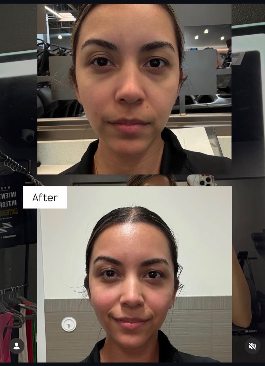 Client before and after The Facelift Method, showing the face and under-eye area